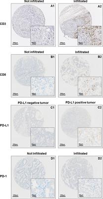 New Artificial Intelligence Score and Immune Infiltrates as Prognostic Factors in Colorectal Cancer With Brain Metastases